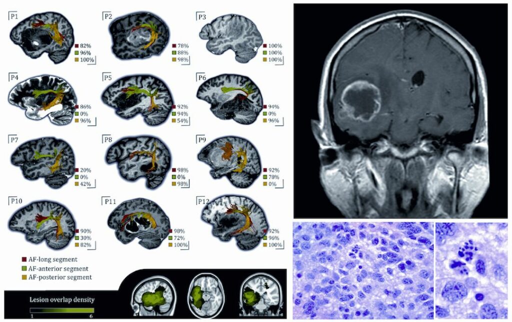 El Diagn Stico Y Tratamiento Del Glioblastoma Durante La Crisis