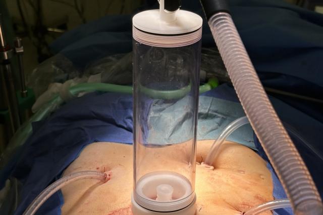 Primera cirurgia per laparoscòpia de Citorreducció Quirúrgica amb Quimioteràpia Hipertèrmica Intraperitoneal a l’HUB