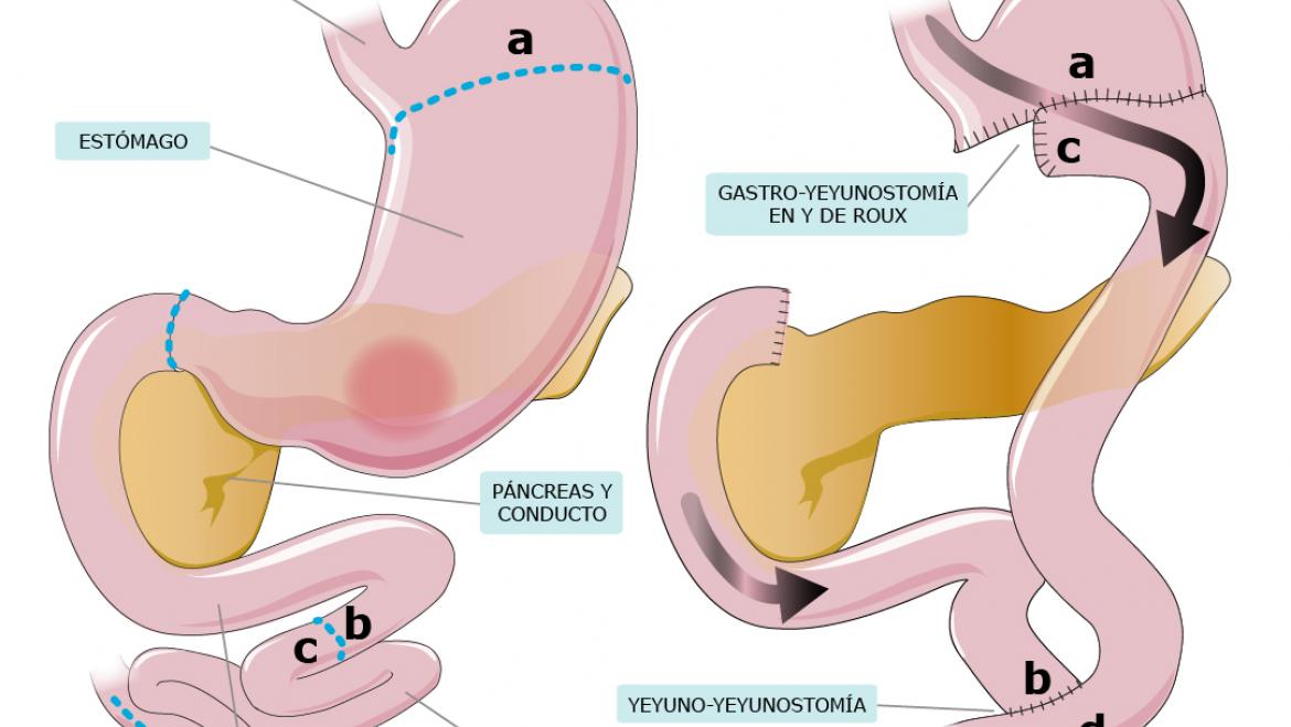 gastrectomia subtotal
