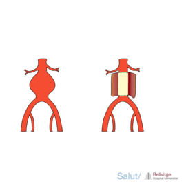 Aneurisma aorta abdominal endovascular HUB Aneurisma aorta abdominal endovascular HUB