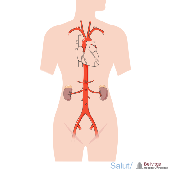 Aneurisma aorta abdominal endovascular HUB