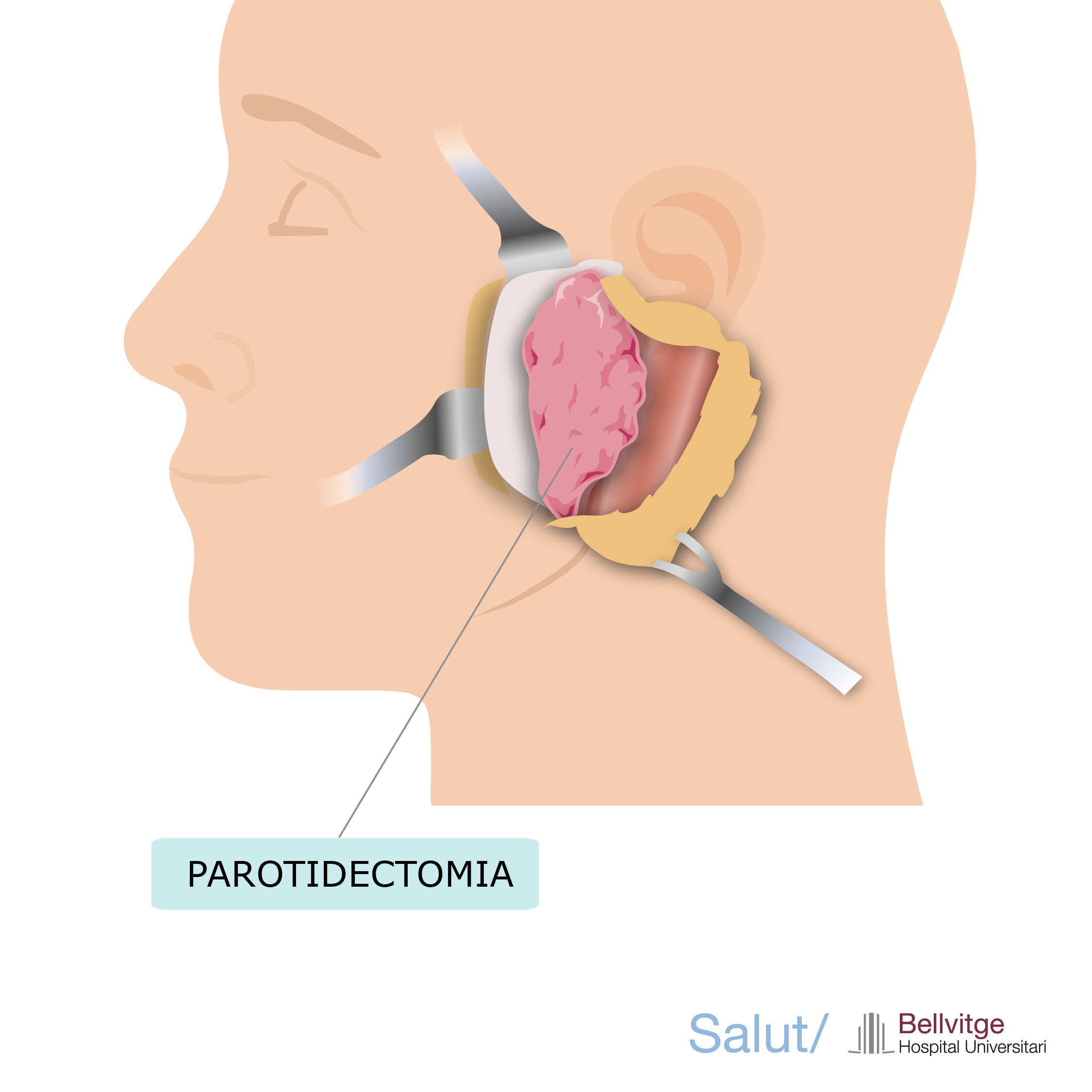 abordatge parotidectomia HUB