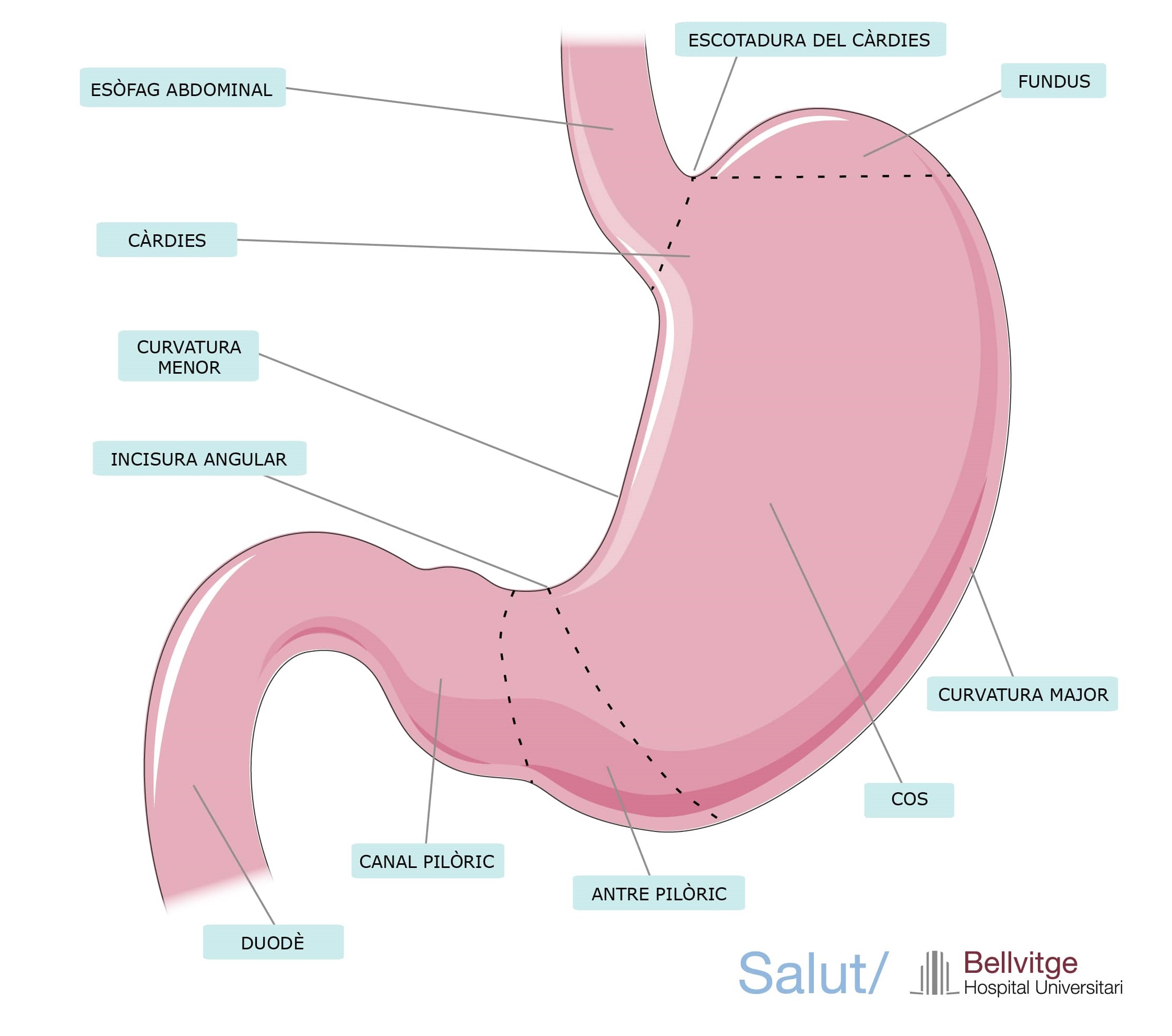 Gastrectomia HUB