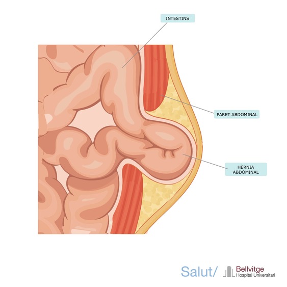 Hernia HUB Hernia HUB