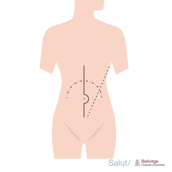 Aneurisma aorta abdominal endovascular HUB Aneurisma aorta abdominal endovascular HUB