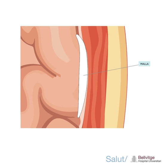 Hernia HUB Hernia HUB