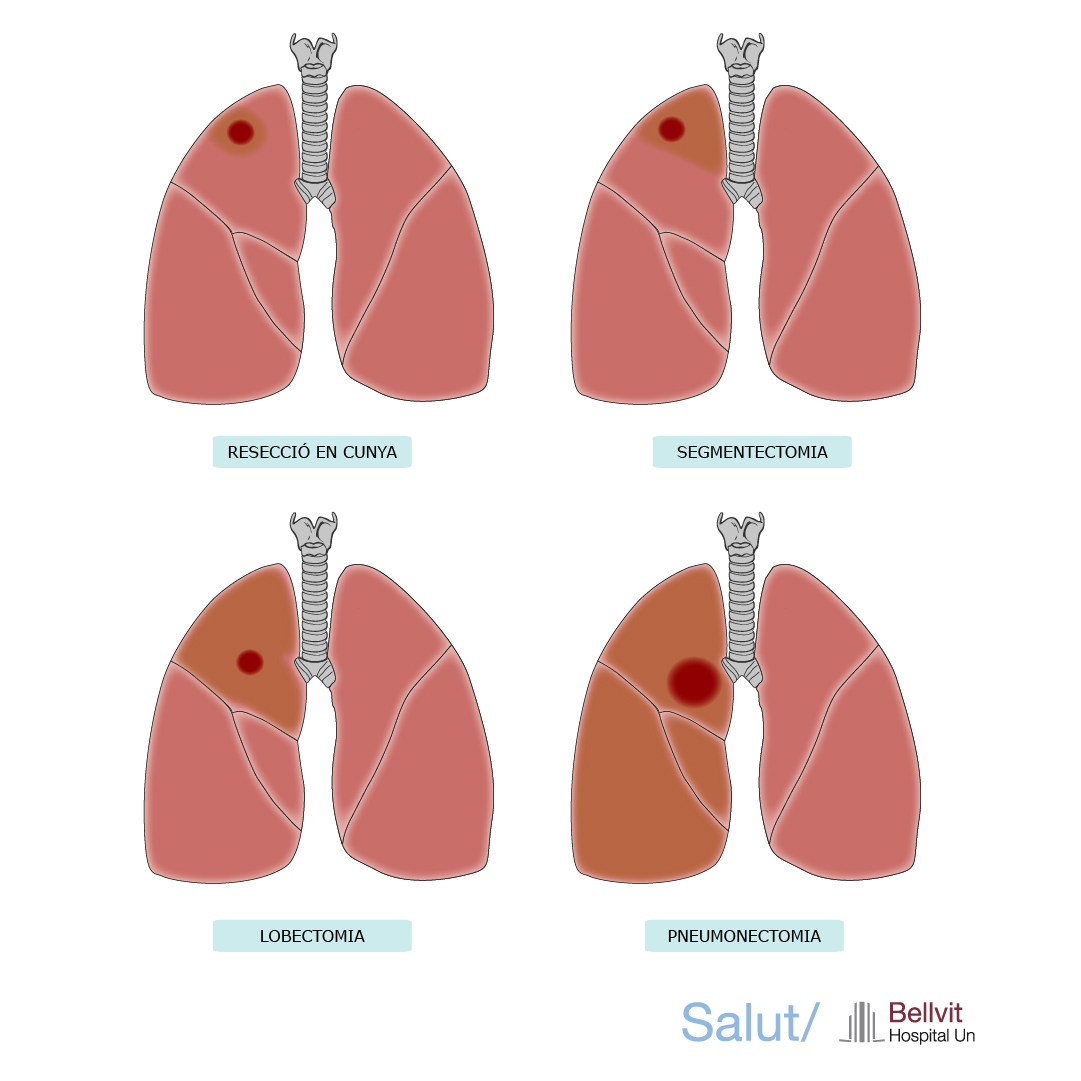 Resecció pulmonar HUB