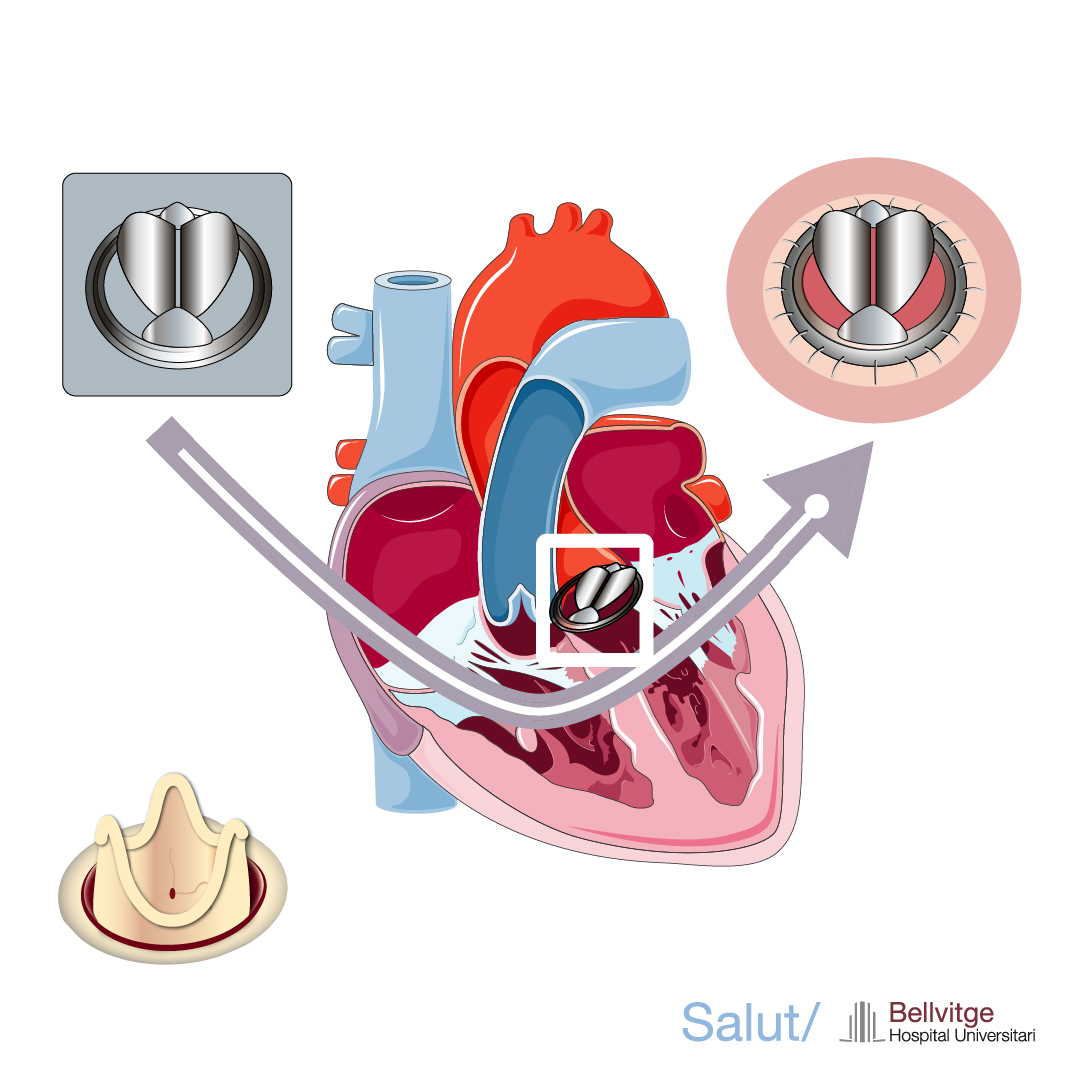 valvula aortica