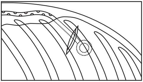  Fig.1 Col·locació del dispositiu CELSITE© Drainaport a la zona subcutània del tòrax a la part lateral.