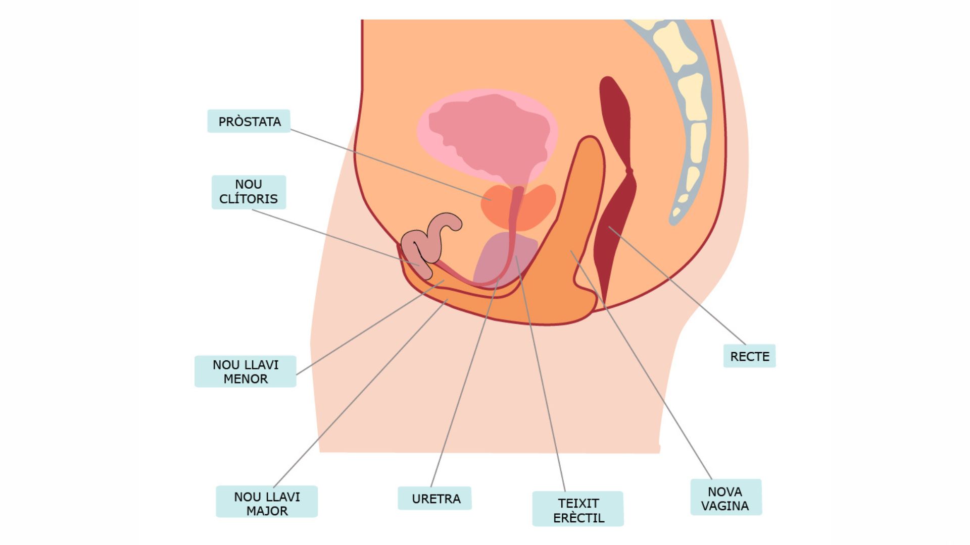 vaginoplastia