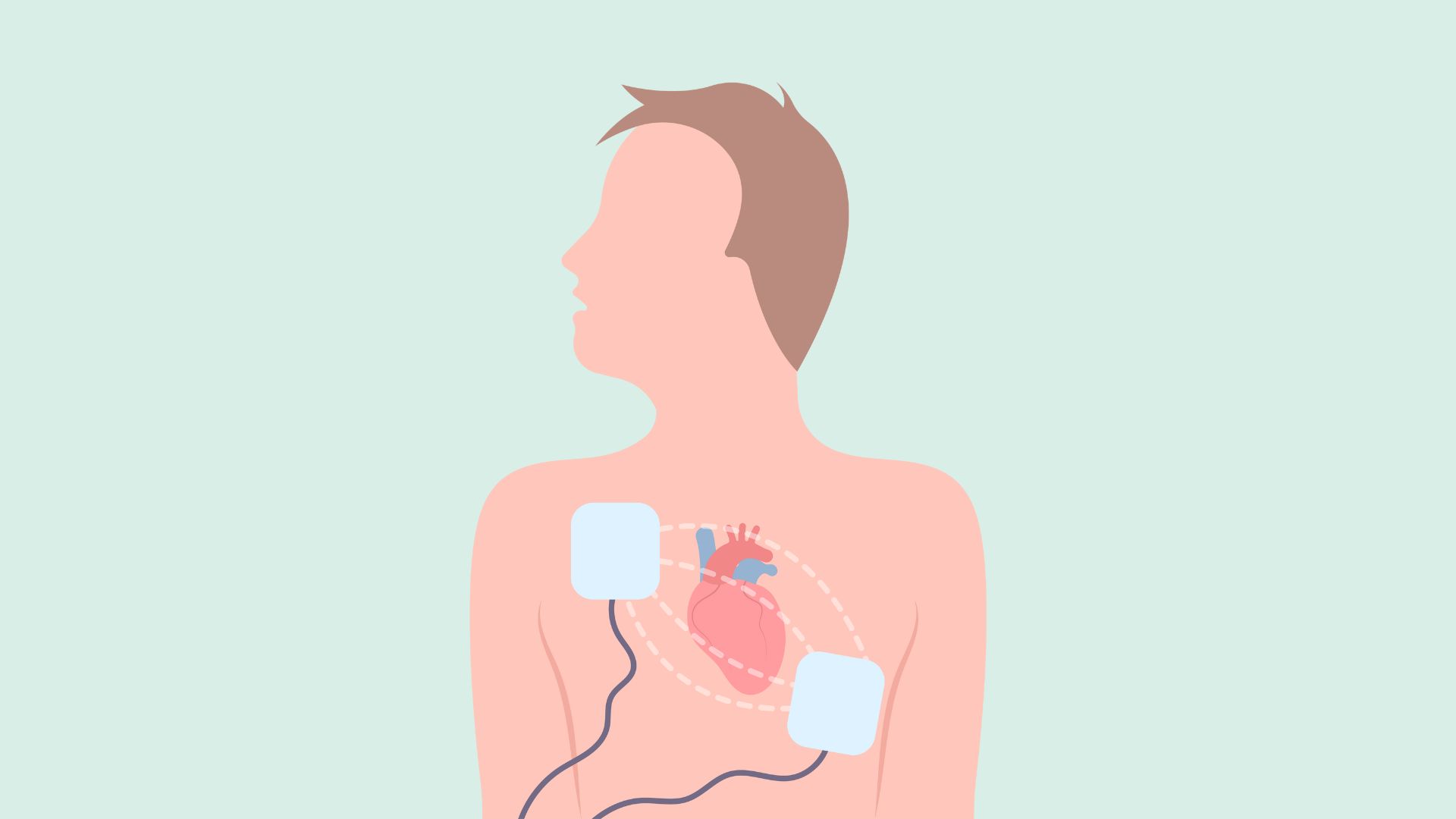 cardioversio electrica