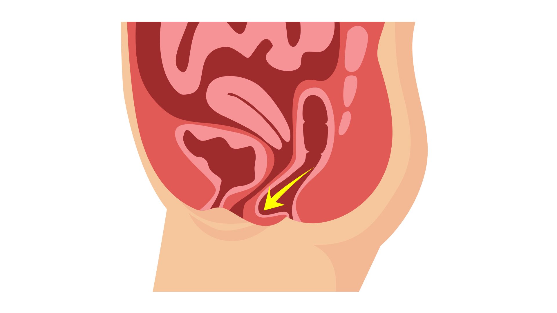 Cirurgia de prolapse genital