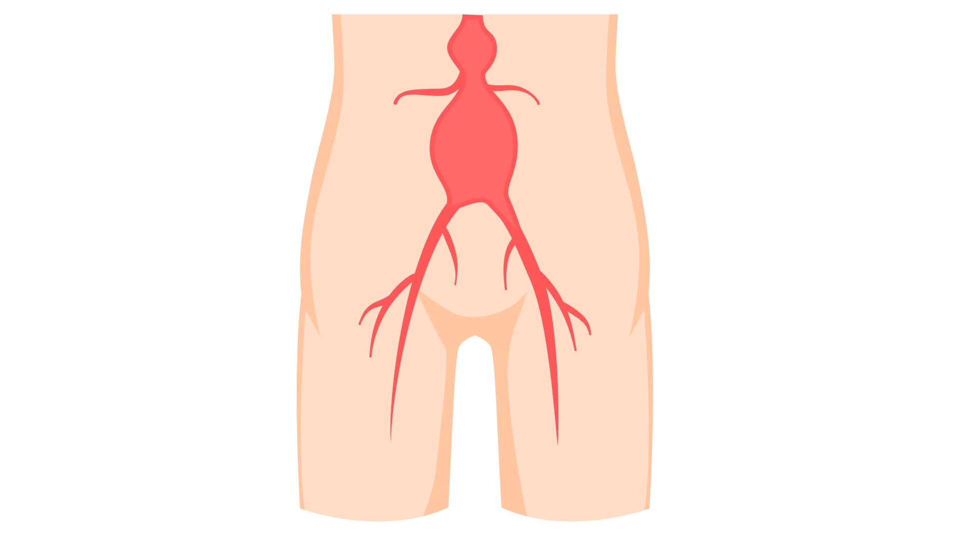 Aneurisma aorta abdominal amb cirurgia oberta