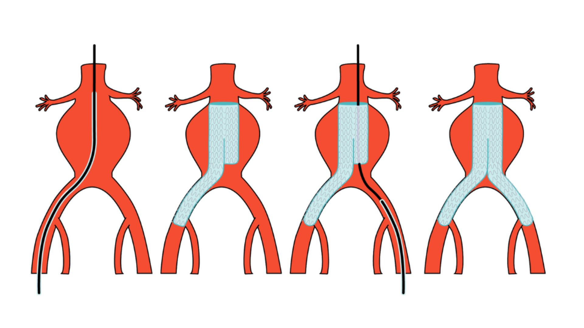 Aneurisma aorta abdominal endovascular: informació clau | Hospital de ...