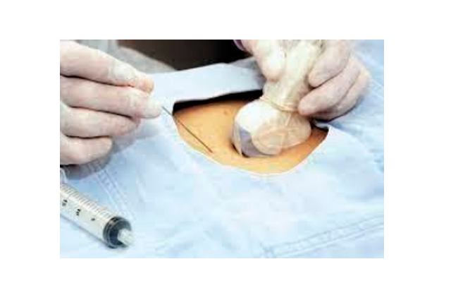 Formació i Seguiment en les Tècniques de Nefrolitotomía Percutània amb Punció Ecoguiada