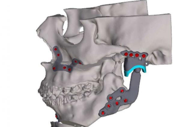 L’Hospital de Bellvitge dissenya i implanta una pròtesi pionera per recuperar la funcionalitat i la simetria de la mandíbula d’una pacient