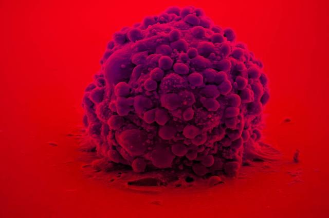 Un pegat inspirat en els musclos podria ajudar a reduir la recaiguda del tumor cerebral més agressiuUn pegat inspirat en els musclos podria ajudar a reduir la recaiguda del tumor cerebral més agressiu