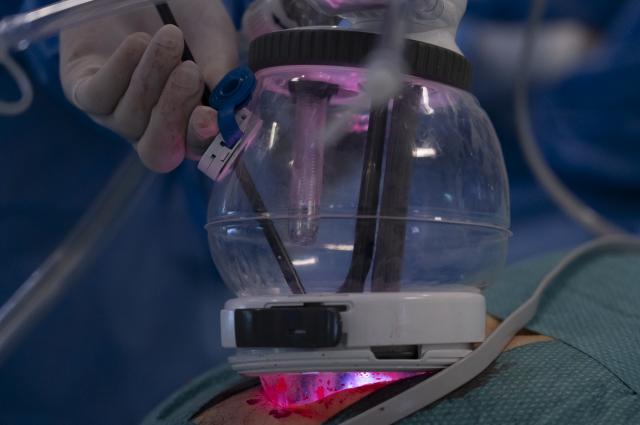 L’Hospital de Bellvitge realitza el primer trasplantament renal a Europa amb cirurgia robòtica d’una única incisió