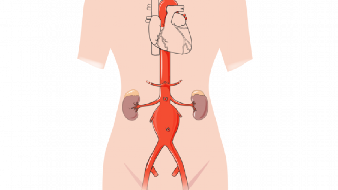 Aneurisma aorta abdominal endovascular HUB