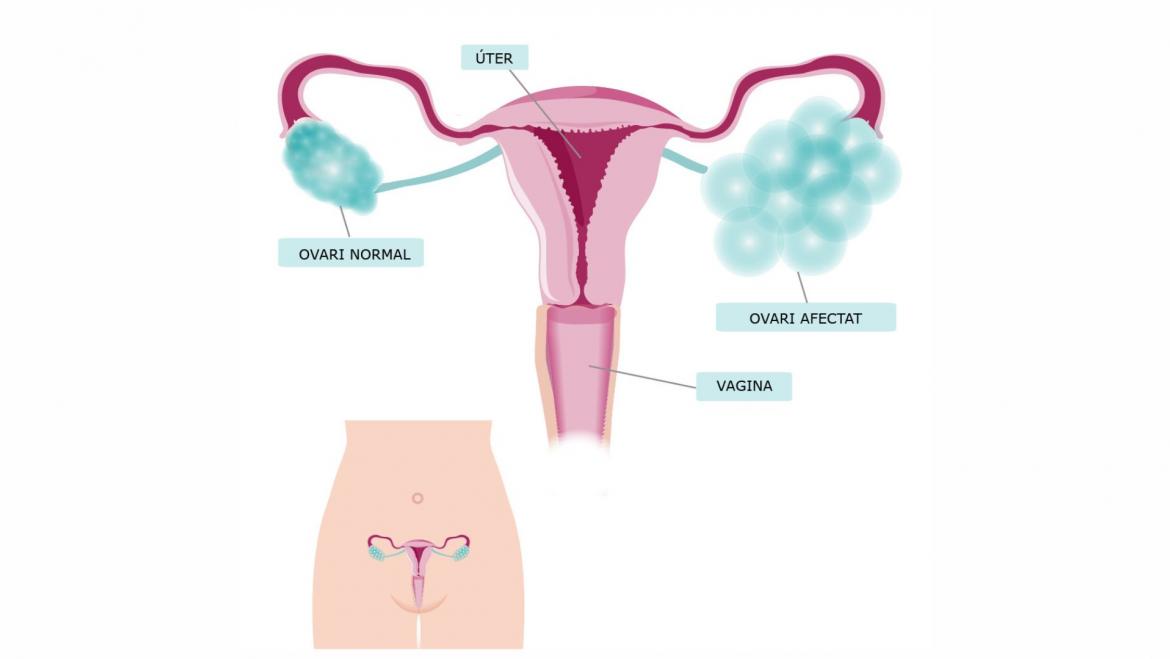 tumor ovari