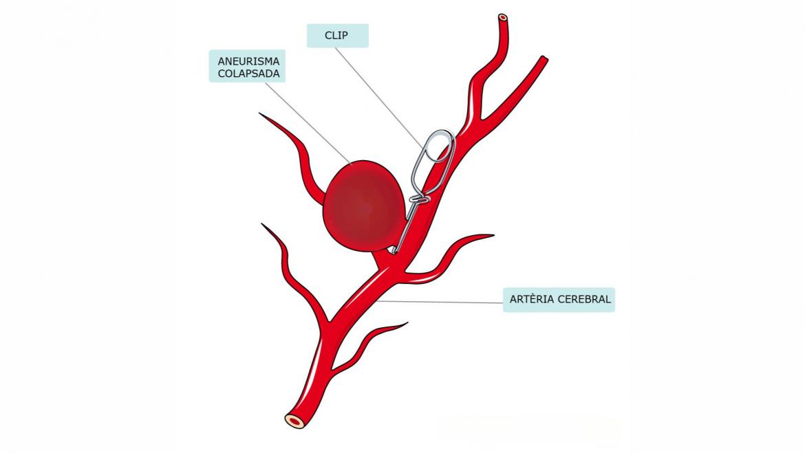 clip aneurisma
