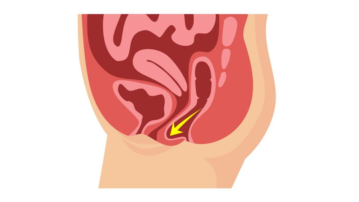 Cirurgia de prolapse genital