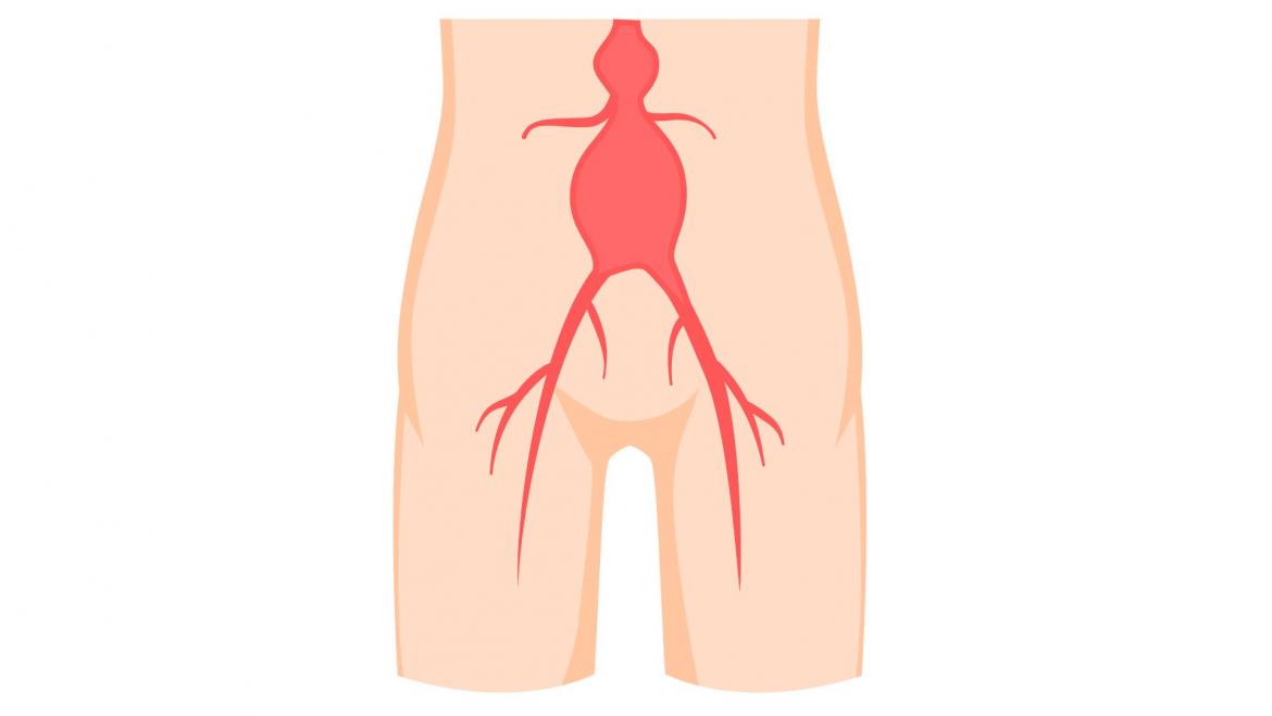 Aneurisma aorta abdominal amb cirurgia oberta