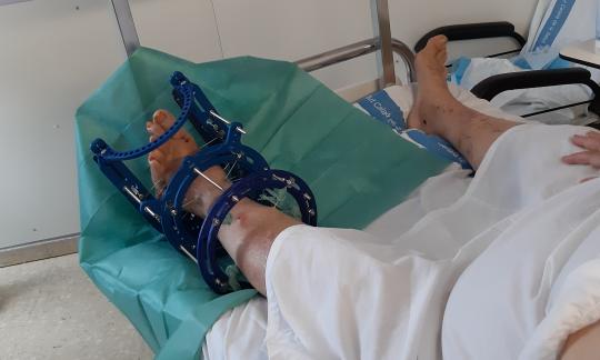 La Unitat de Peu i Turmell implanta un innovador fixador per tractar una greu deformitat del peu